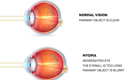 Myopia-phy Form Four